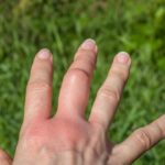 Bee Sting – Agriculture Dictionary