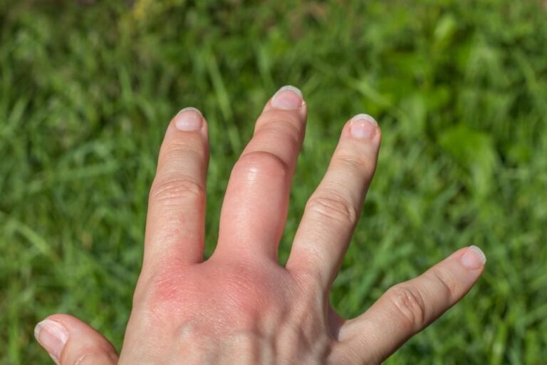 Bee Sting – Agriculture Dictionary